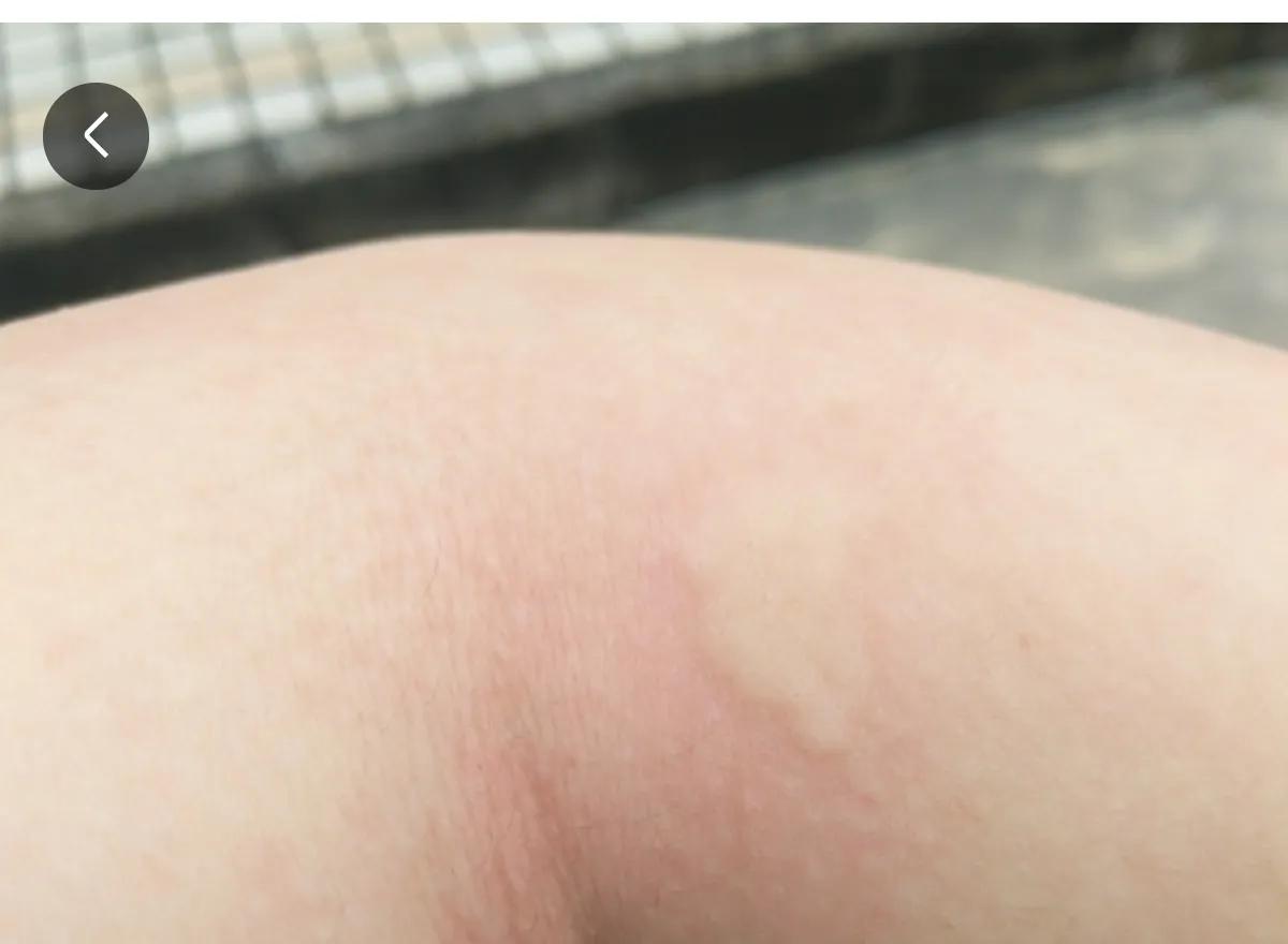 被墨蚊咬了身上全是小红点,被墨蚊子咬了怎样治疗