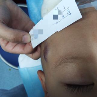 混合型血管瘤的治疗办法,混合型血管瘤的最佳治疗方法