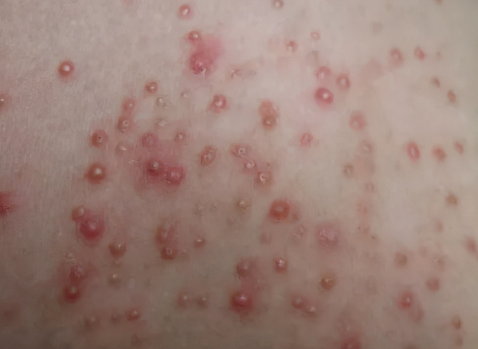 太苦了太苦了，背后长痘的女生都太苦了