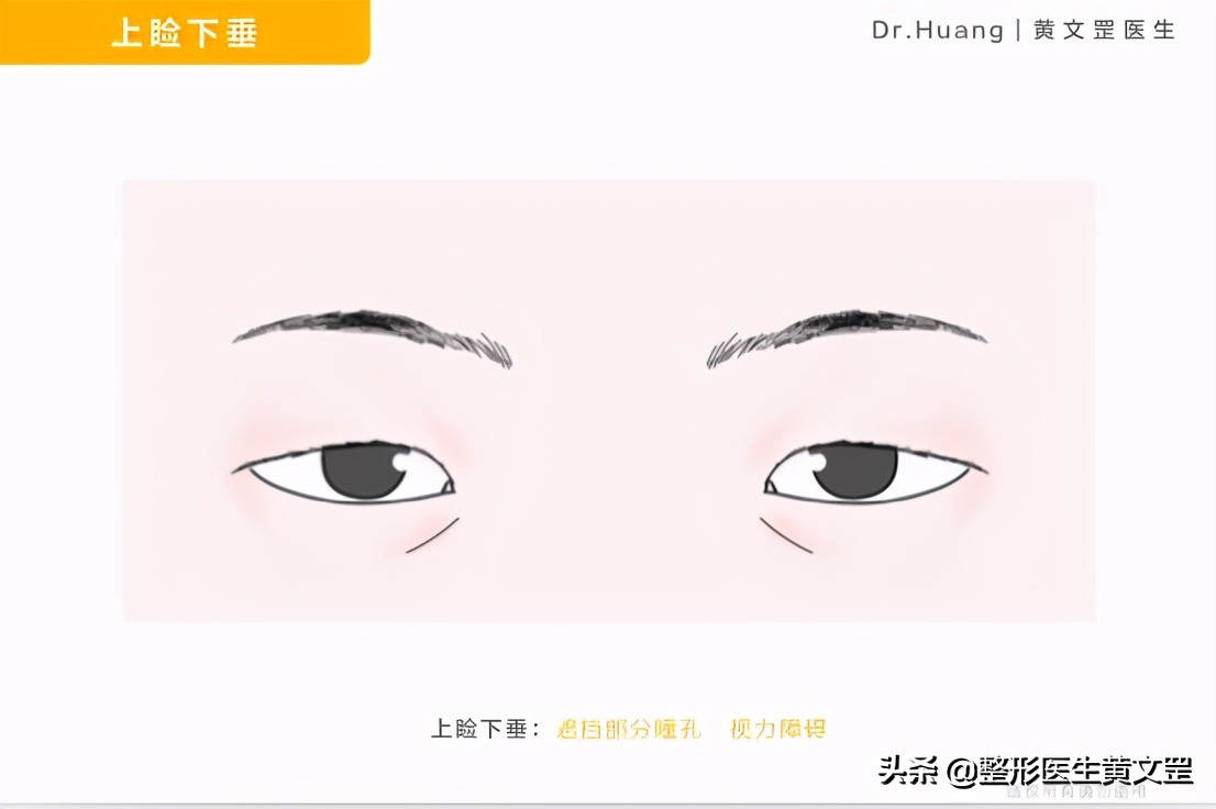 你的眼睛为什么看起来那么凶？三角眼该怎么办？