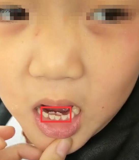 6岁小孩长出双排牙是不是龅牙,孩子长出双排牙只因父母爱太多