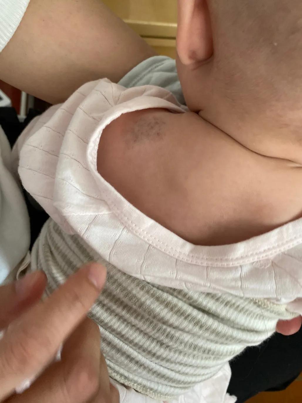 宝宝血管瘤用眼药水以后1个月淡化好多（带图）