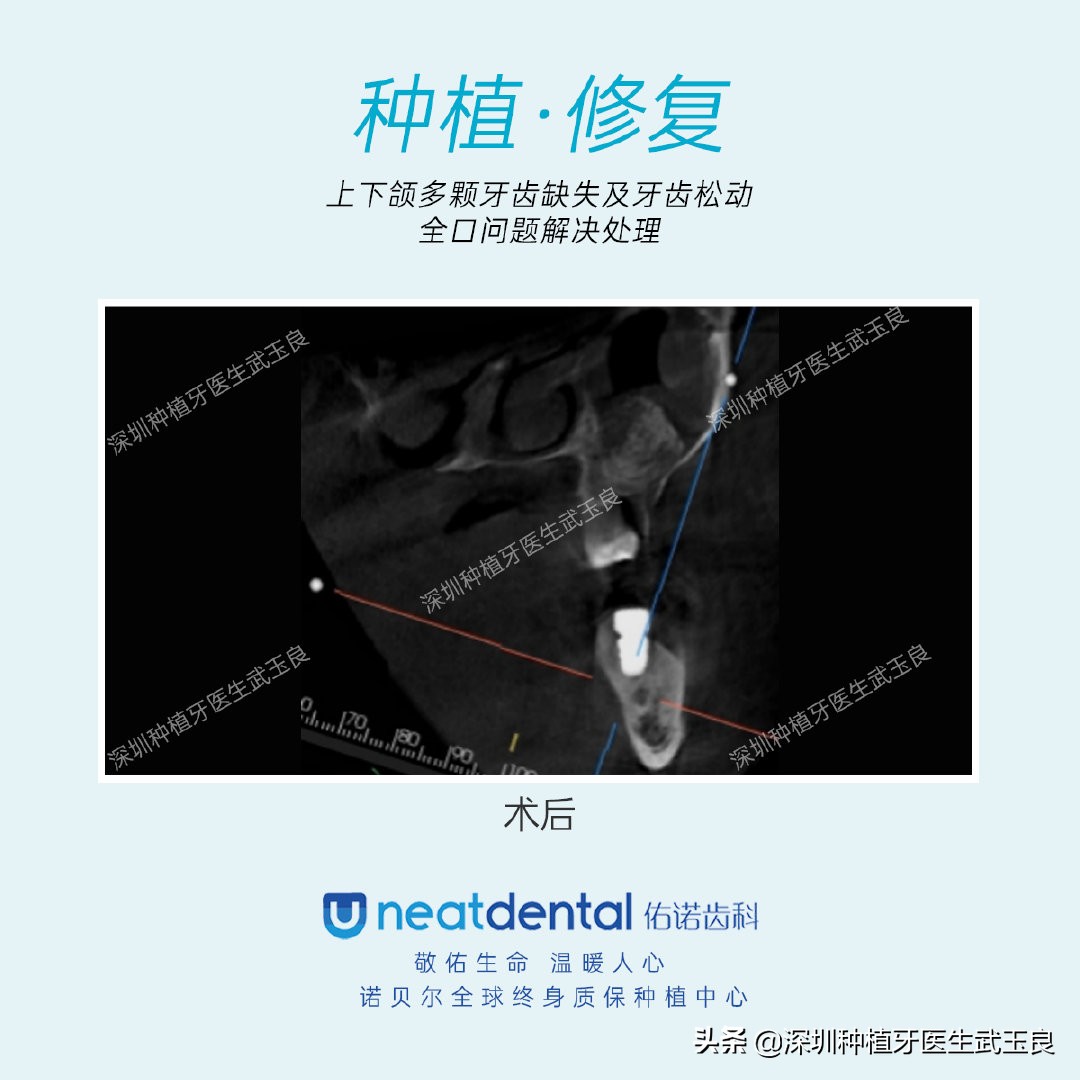 多颗牙齿缺失怎么修复全过程,多颗缺失牙修复案例