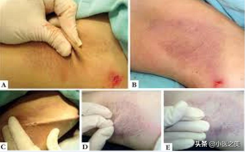 如何治狐臭腋下出汗,腋下轻微出汗有腋臭怎么治