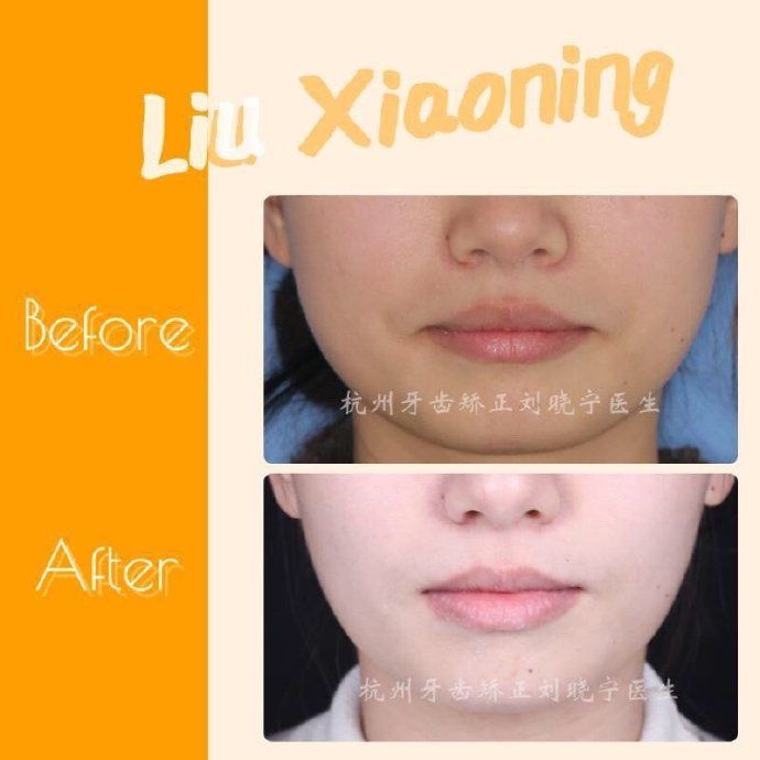 杭州舌侧牙齿矫正,舌侧矫正杭州价格