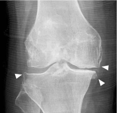 膝关节骨刺疼痛用艾灸有用吗,膝关节骨刺疼痛口服药
