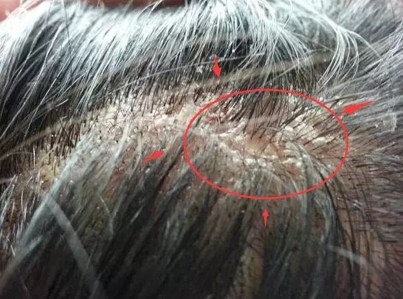 有头皮屑头痒用什么药治,头皮屑多头痒用啥洗发水