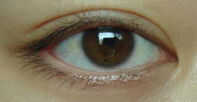 为什么眼白会有色素斑,为什么眼白上有红血丝和黑点