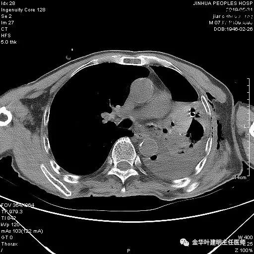 肺手术后乳糜胸是医疗事故吗,肺部切除后乳糜胸治好了