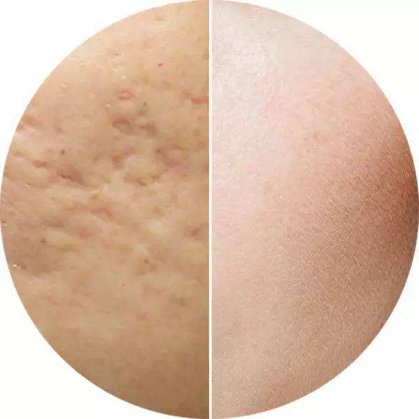 能根治痘痘痘印最好的办法,怎么祛除痘痘痘印和痘坑小妙招