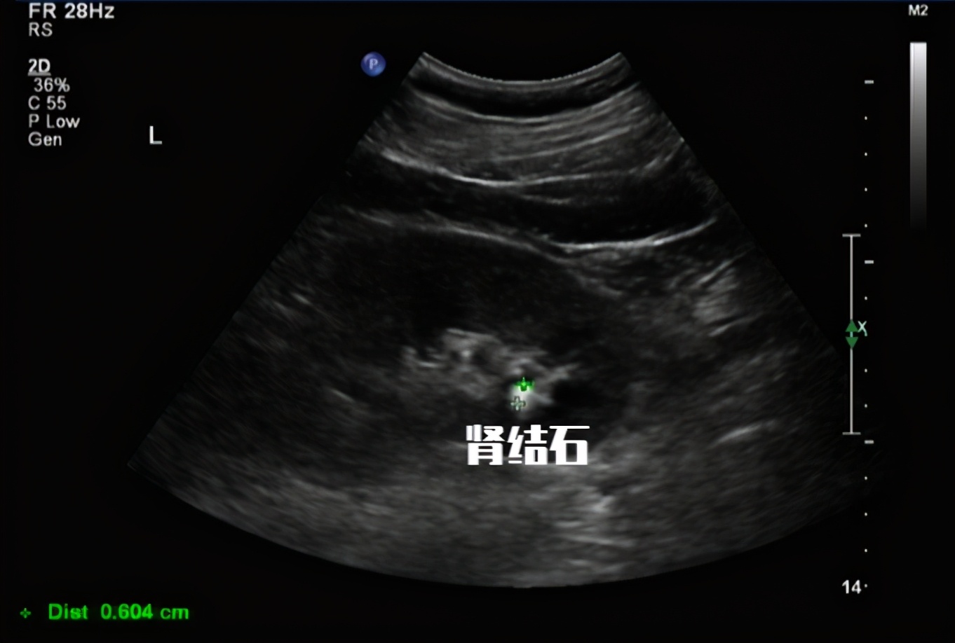 尿隐血3+是不是尿道炎,尿常规隐血3+红细胞高是肾炎么