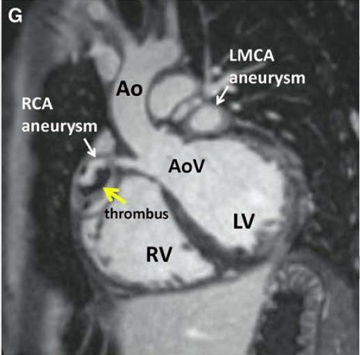 给儿童带来相对长时间发热的「川崎病」该如何治疗？
