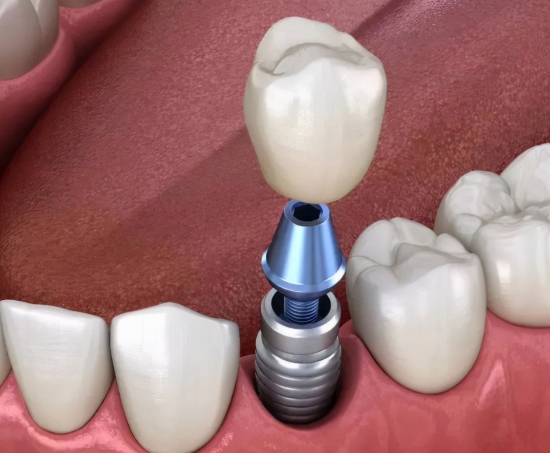 老人做种植牙有什么年龄限制吗,老年人做种植牙有什么风险