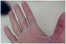 宝宝手指脱皮怎么办,夏天手指脱皮怎么办