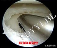 半月板修复视频教程,半月板术后修复