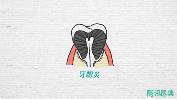 口腔医生：牙缝里的牙垢又臭又硬，教你几个小妙招，牙龈不再出血