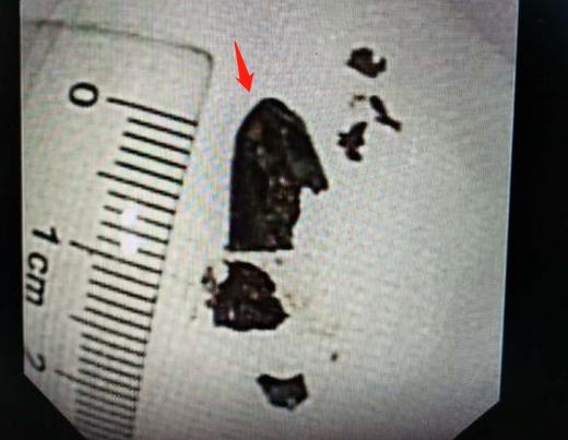 26岁确诊肺癌,26岁得了肺结核