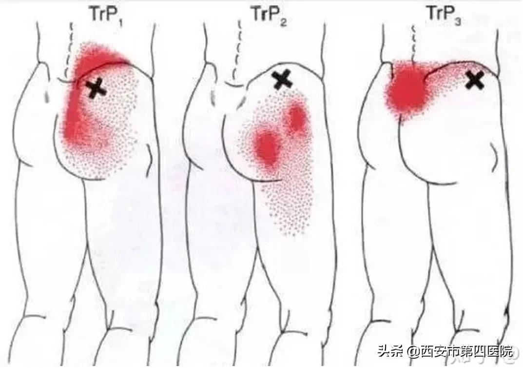 产后腰疼腿疼是怎么回事,产后月子胯部痛
