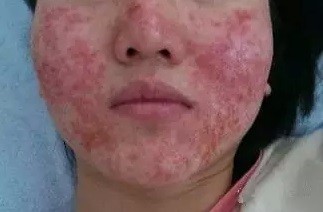 接触性皮炎的症状表现图片,接触性皮炎几天会好小妙招来帮你