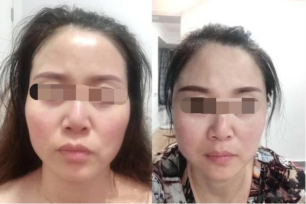 面部凹陷显老怎么整,女生脸部凹陷怎么补救