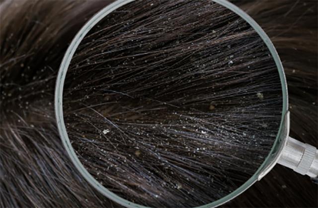 头皮屑最简单的解决方法,头皮屑的原因及解决方法