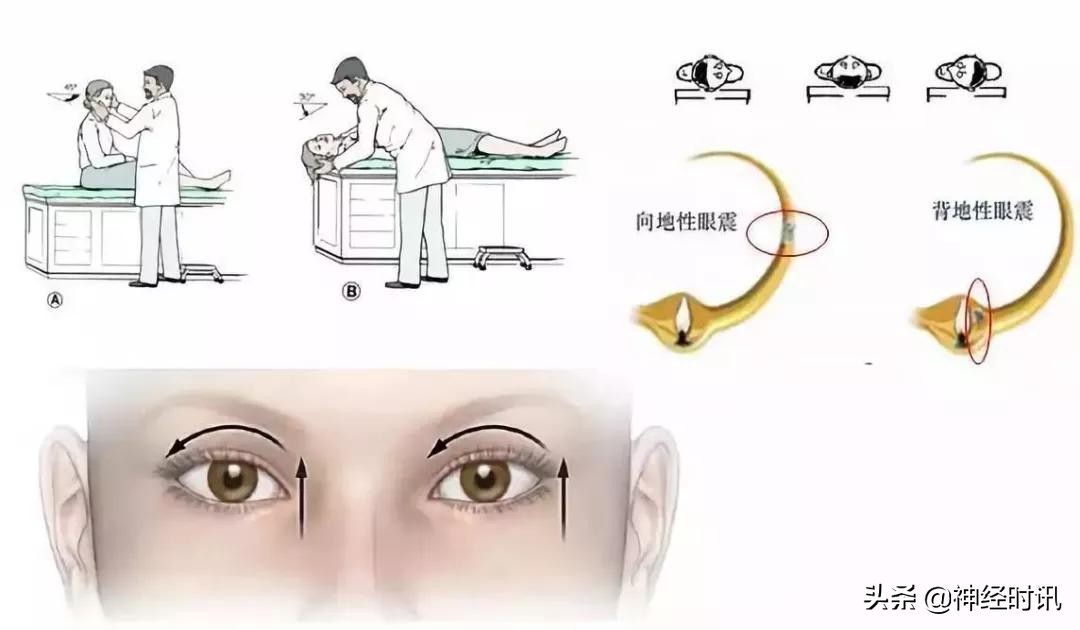 位置性眩晕手法复位示意图,位置性眩晕鉴别诊断