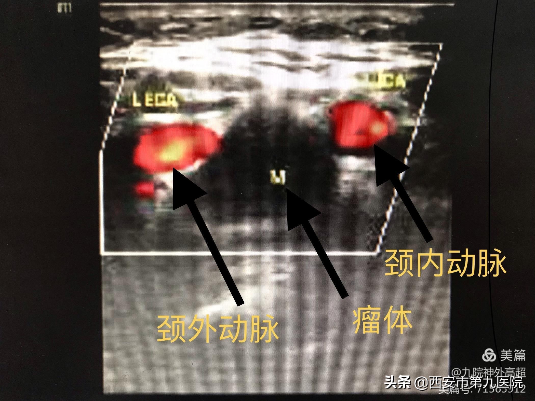 脖子上长一个神经瘤需要手术吗,颈动脉上有个凸起疑是动脉瘤