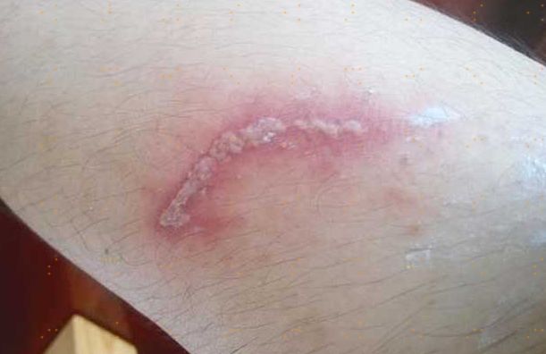 毒蚂蚁隐翅虫,被有翅膀的蚂蚁蛰了有毒吗