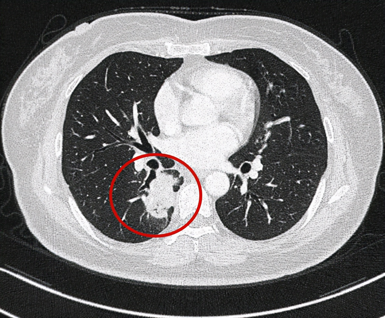 问诊分析：右下肺占位伴多发小结节，如何考虑？
