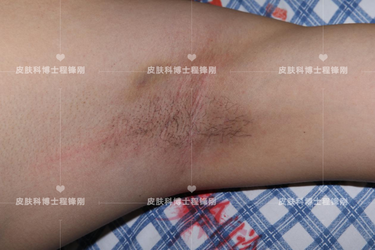 十七岁同学有遗传腋臭最好办法,遗传狐臭可以彻底根治吗