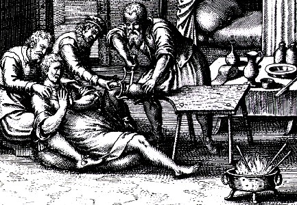 烙铁治疗痔疮,用热烙铁能治痔疮吗