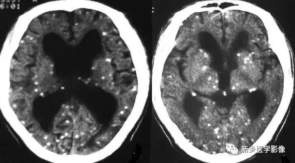 颅内有钙化怎么治疗,34岁脑部有钙化正常吗