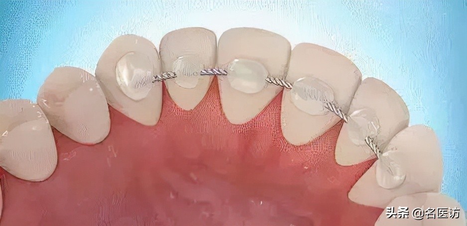 牙齿矫正不戴保持器会全部反弹吗,牙齿矫正保持器戴久了脸会变形吗