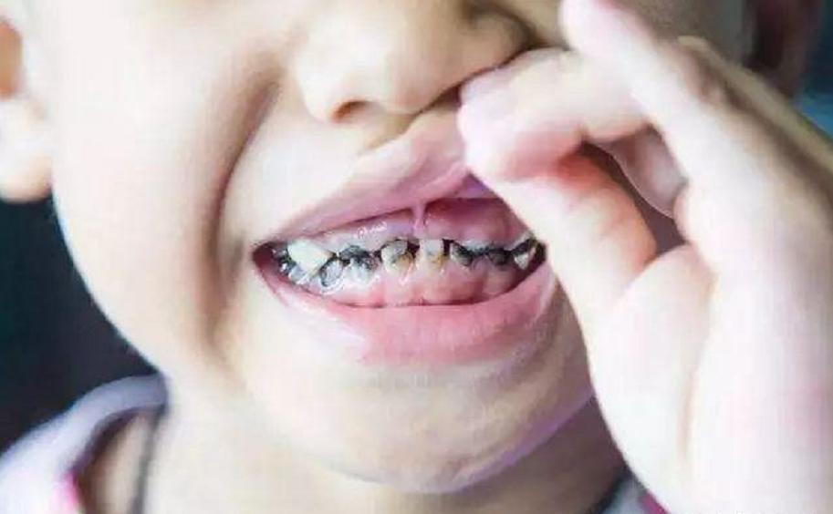 小孩天天刷牙为什么还长虫牙,天天刷牙为啥小孩的牙齿会黑