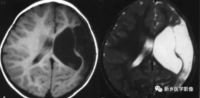 影像学脑室扩大,脑室显大怎么理解