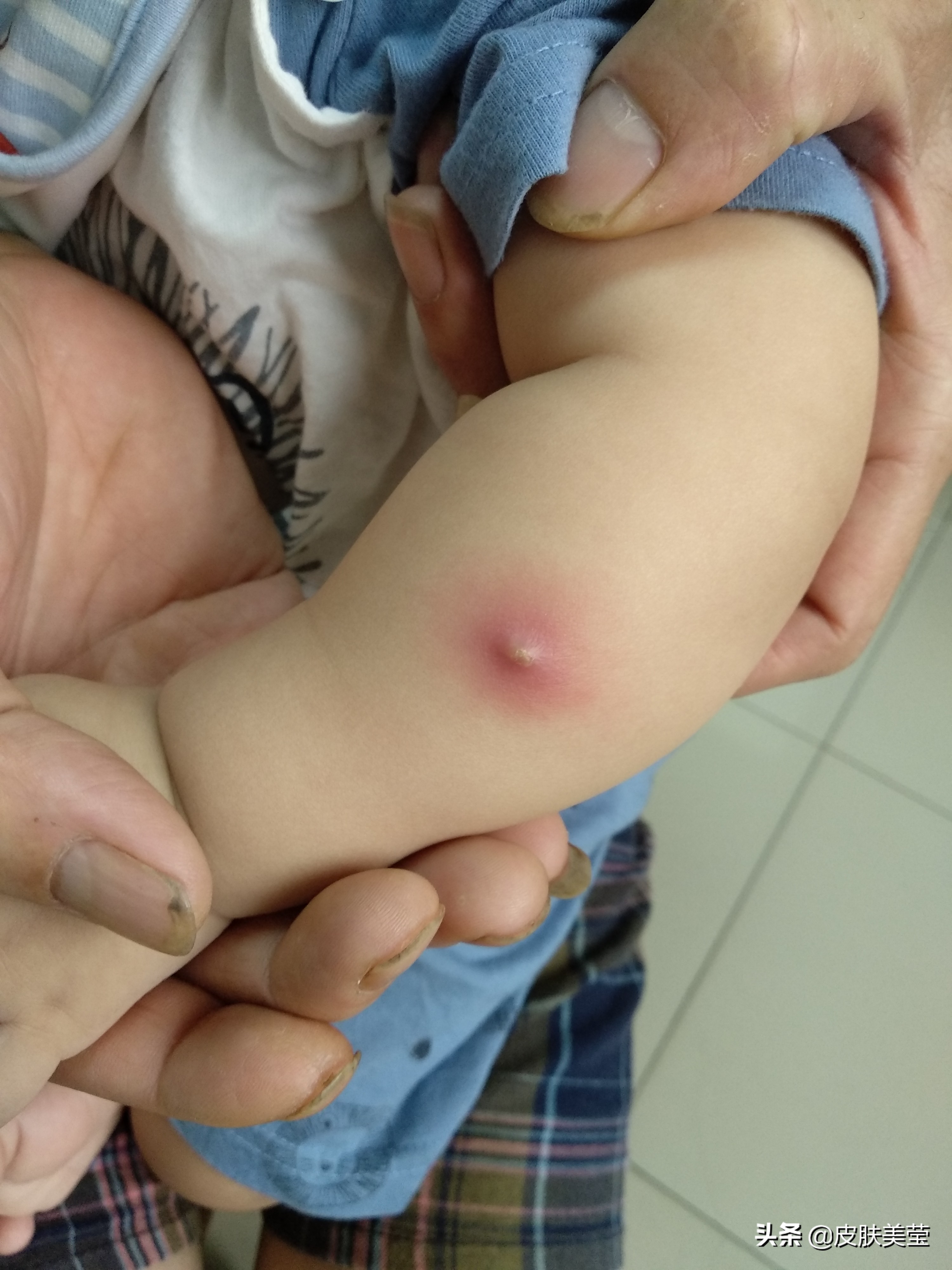 火疖子最怕什么,自行处理火疖子需要注意什么