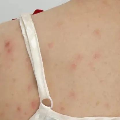 又到了穿小裙的季节，鸡皮女孩该怎么办……