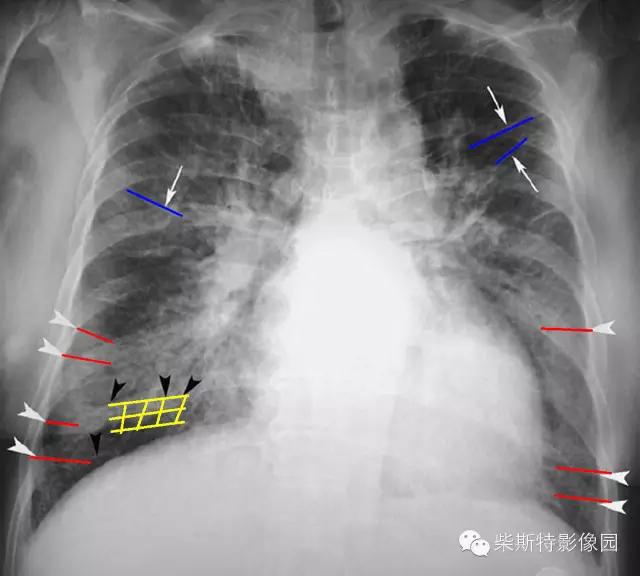 影像经典之KerleyA线、KerleyB线、KerleyC线