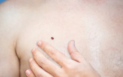 鲜红斑痣对婴幼儿胎记有什么影响,宝宝鲜红斑痣胎记去除的最好方法