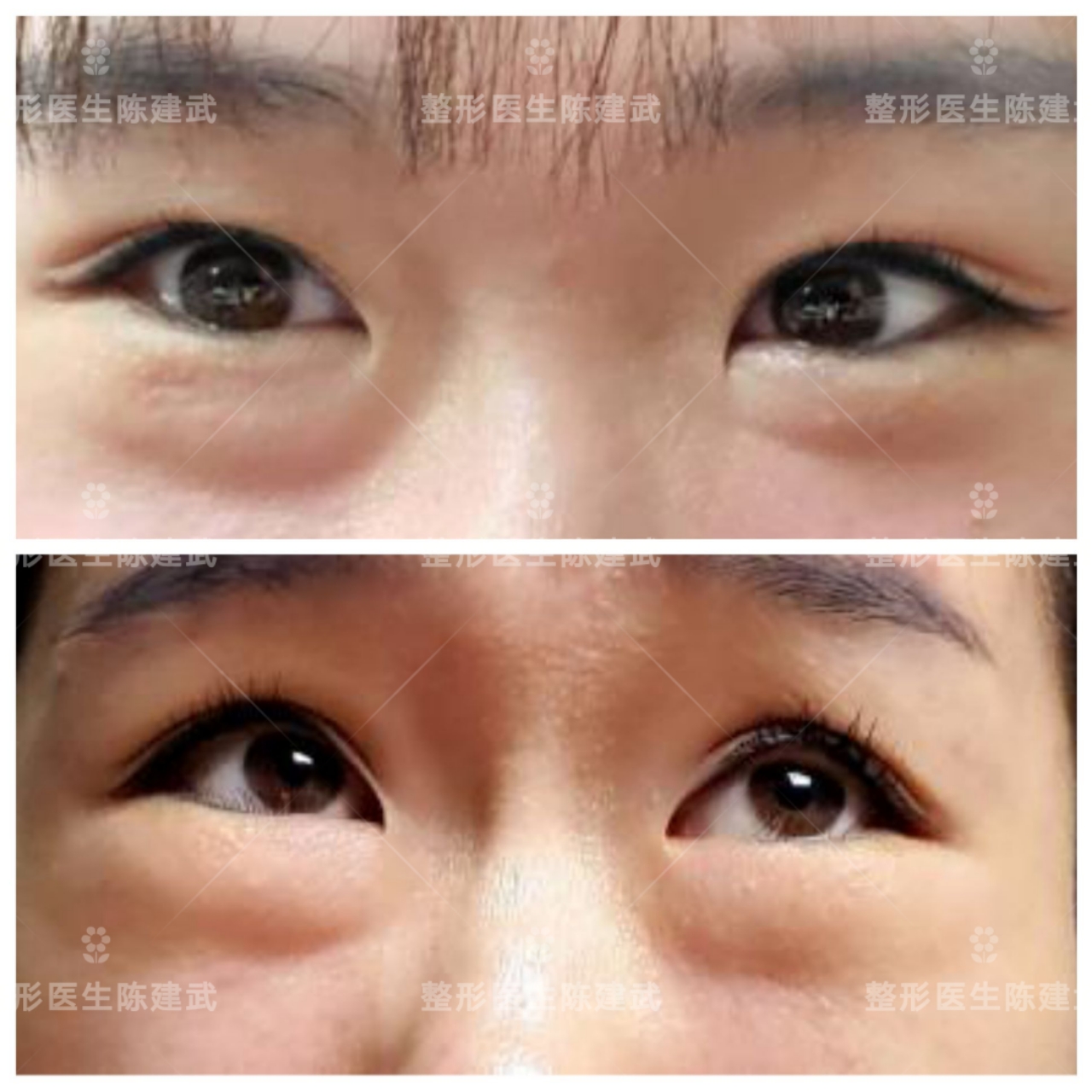 同姐妹们分享：天生肿泡眼，割完眼袋后，竟然要二次修复？