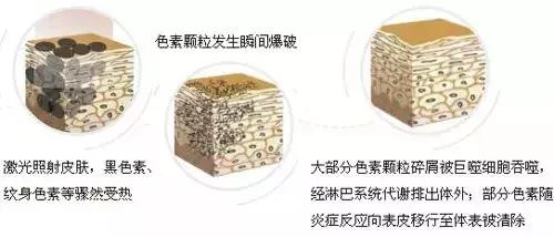 激光祛斑后会复发吗会产生反弹吗,激光祛斑复发