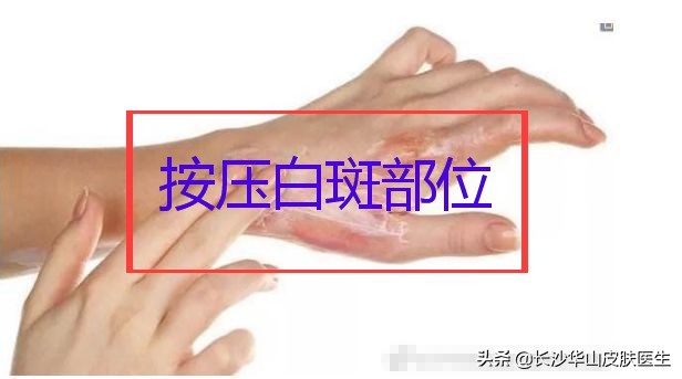 白癜风早期症状为什么会得白癜风,白癜风早期表现和白癜风发病部位