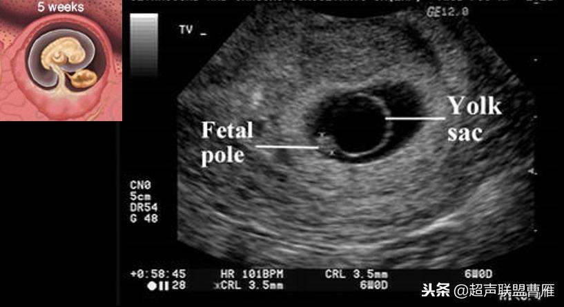 3毫米卵黄囊未见胎芽正常么,40多天的卵黄囊
