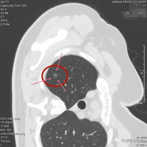 从活检怎么看是非小细胞癌,从病例谈辨证论治