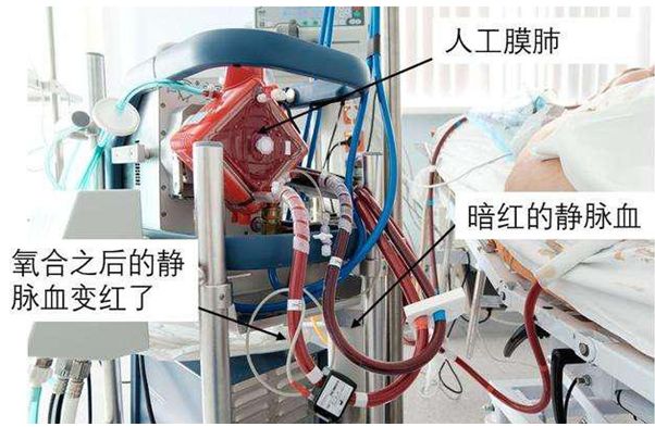 ecmo可以抢救心梗吗,ecmo抢救还有意识吗
