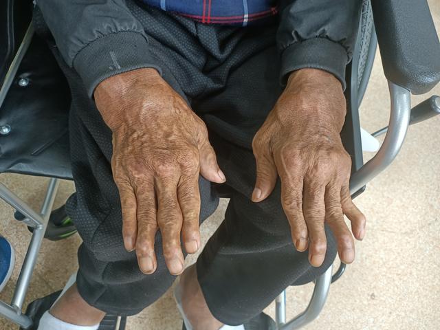 生物制剂治疗类风湿多长时间见效,生物制剂治疗类风湿多久能稳定