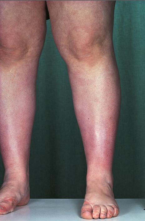 结节病关节痛眼睛模糊,结节病引起的关节炎