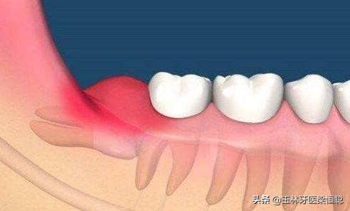 拔除智齿后干槽症的症状,智齿拔掉干槽症症状