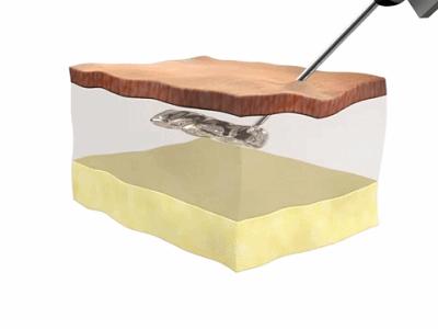 额头皱纹除皱教程,细节美容手法