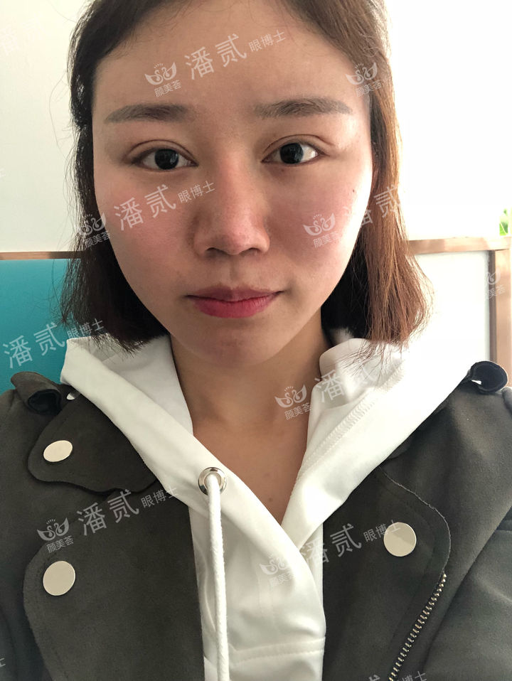 开眼角过大图片,开眼角过大修复效果图